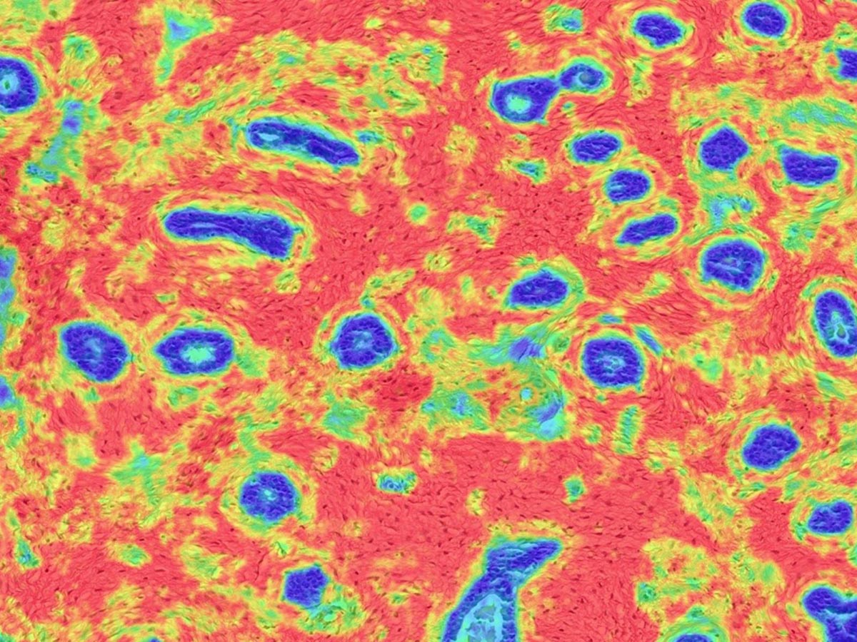 NIH Researchers Identify Tissue Biomarker for Breast Cancer Risk